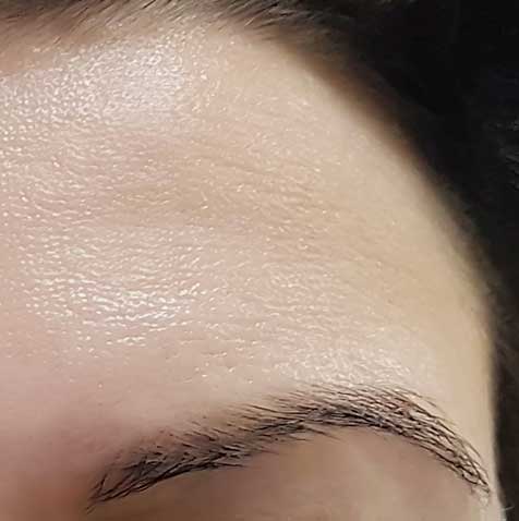 Fine Lines Treatment