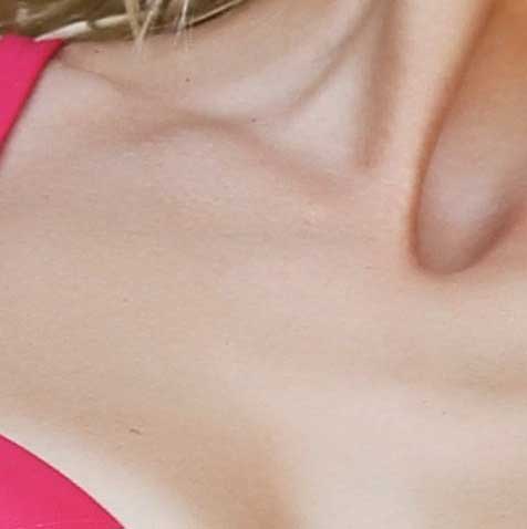 IPL / Intense Light Therapy