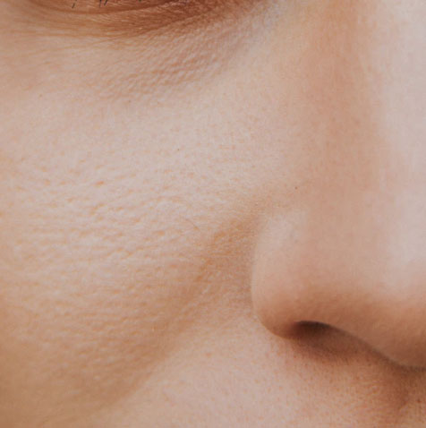 Vampire Facial Treatment